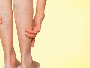 Kojų sunkumas, skausmas ar tinimas? Klastingas negalavimas, kurio nevalia ignoruoti